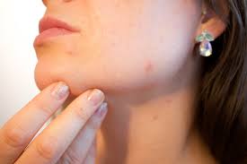 adult acne, cheeks acne 2