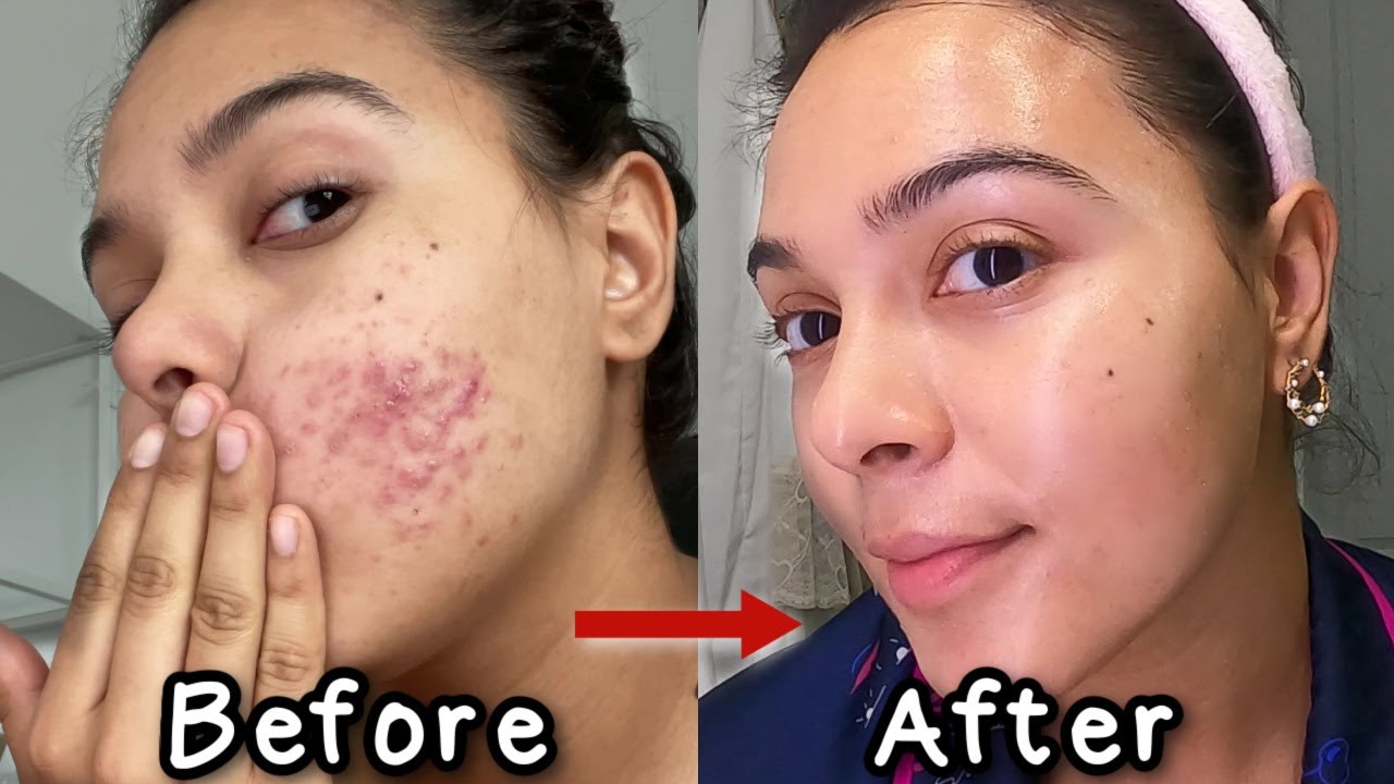 How I Got Rid of My Acne *3 products that changed my life* | NataliesOutlet